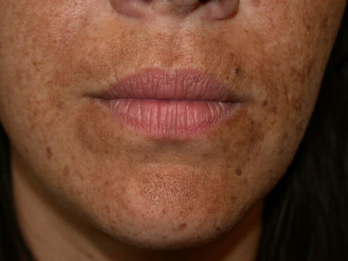 Macchie di pigmento sul viso sono un'indicazione della chirurgia laser