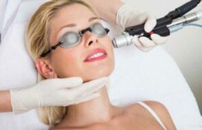 Procedura laser per il ringiovanimento della pelle del viso