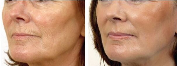 Prima e dopo la ciotola laser