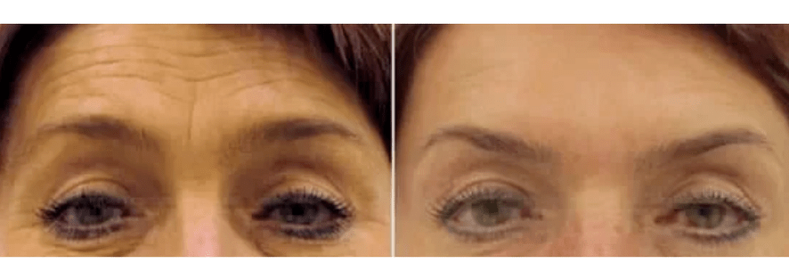 Dispositivi per il ringiovanimento frazionato