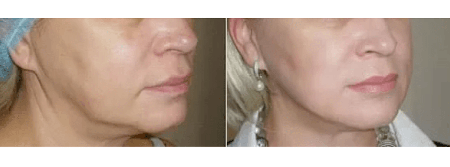 Recupero dopo il ringiovanimento della pelle