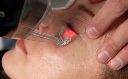 Procedura di ringiovanimento della pelle del viso con laser